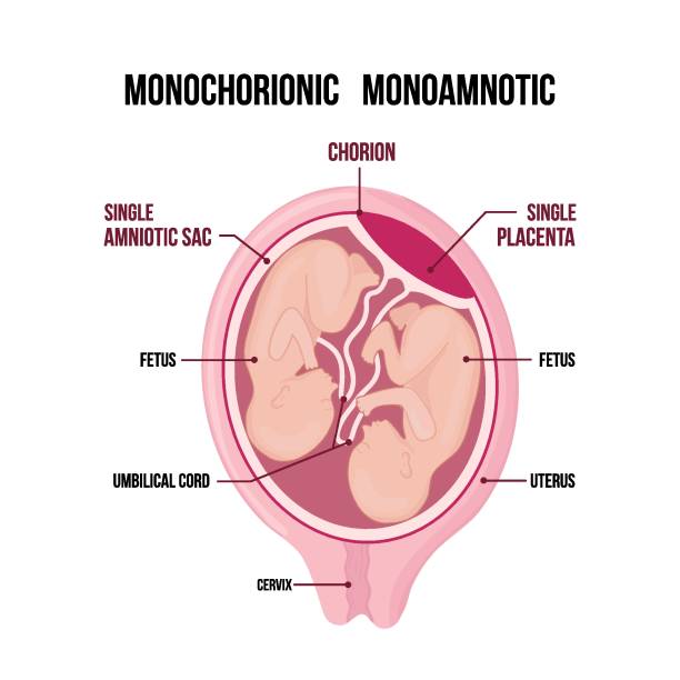 monochorionic monoamniotic twins diagram medyczny wyizolowany na białym tle. - twin fetus uterus human pregnancy stock illustrations