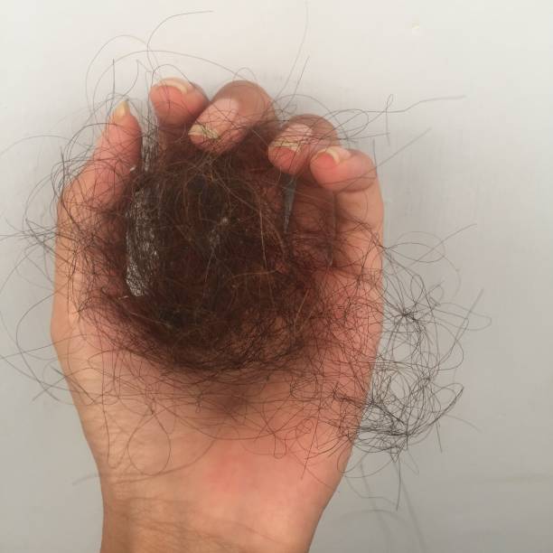 istock Heavy hair loss. 1351992761