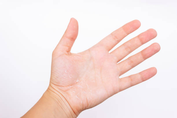 istock A female hand with peeling skin on the palm 1352076353