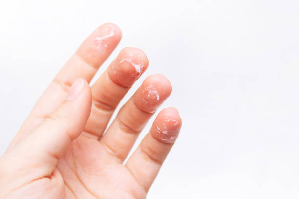 istock A woman's hand with peeling skin on the fingers 1352076373