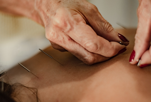 Acupuncturist performing acupuncture treatment by applying needles with his hands on his back.