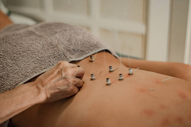 moxaterapia treatment known as moxa therapy or mhashum, from traditional Chinese medicine. It's a kind of acupuncture, without needles, made with moxa. acupuncture model stock pictures, royalty-free photos & images