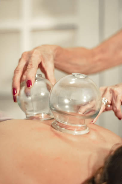 Suction Cup Therapy Suction cup therapy, made by traditional Chinese medicine where it places the suction cups for various treatments. cupping therapy stock pictures, royalty-free photos & images