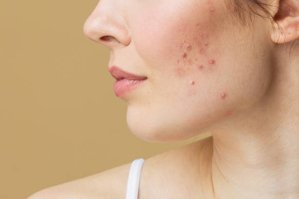 Young woman before and after acne treatment. Skin care concept Young woman before and after acne treatment. Skin care concept hormone stock pictures, royalty-free photos & images
