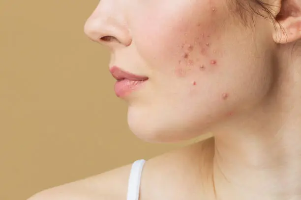 Photo of Young woman before and after acne treatment. Skin care concept