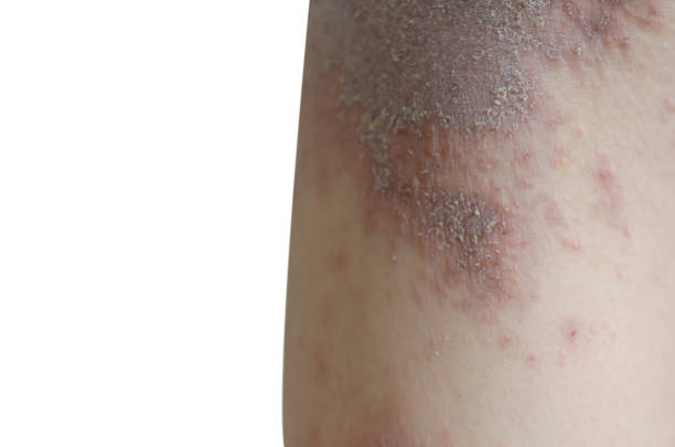 istock Rash and skin on the leg, isolated on white background. 1352151856