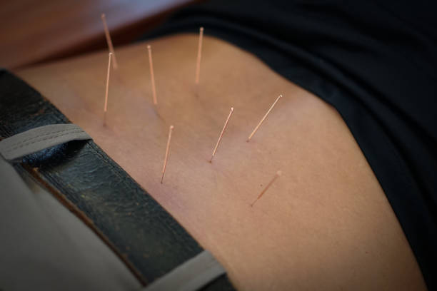 istock Traditional Chinese Medicine Acupuncture on back body 1352166180
