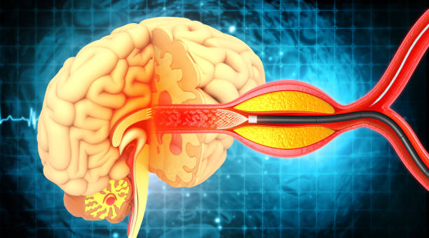 procedimiento de angioplastia con balón con stent en la vena - technology digital display digitally generated image brain fotografías e imágenes de stock