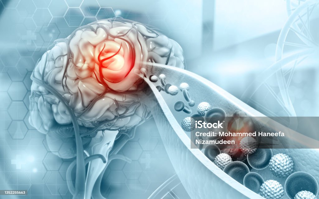 Atherosclerosis Stroke. A blood clot in the vessels of the human brain Stroke - Illness Stock Photo