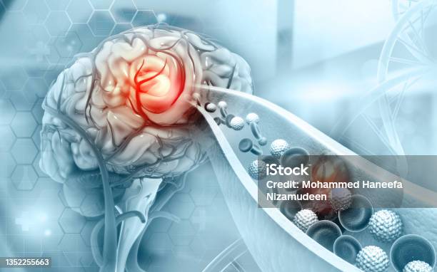 Atherosclerosis Stroke A Blood Clot In The Vessels Of The Human Brain Stock Photo - Download Image Now