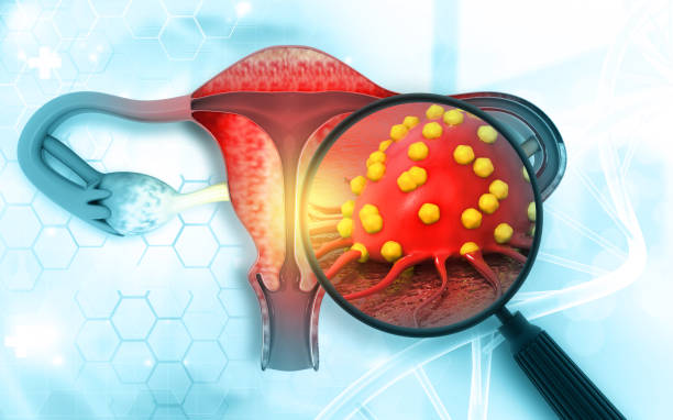 maladies du système reproducteur féminin. cancer de l’utérus et tumeur maligne de l’endomètre en tant que concept médical utérin - cancer cervical photos et images de collection