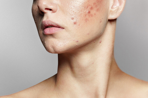 Una mujer joven con mala piel. Piel con muchas espinillas. Enfermedad del acné, tratamiento del acné photo