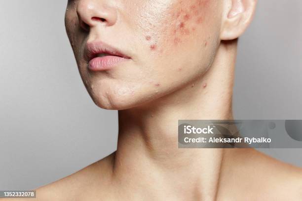 A Young Woman With Bad Skin Skin With A Lot Of Pimples Acne Disease Acne Treatment Stock Photo - Download Image Now