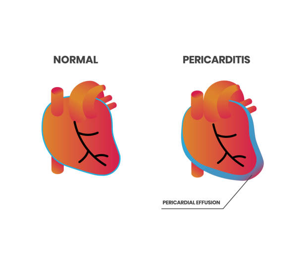 Normal heart anatomy vs pericarditis vector illustration Normal heart anatomy vs pericarditis vector illustration. Pericardium inflmmation with pericardial effusion pericarditis stock illustrations