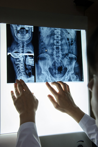 picture of a woman doctor exploring spinal x-ray: lumbar and cervical region - first 2 cervical vertebrae (axis and atlas), the coxofemural joint