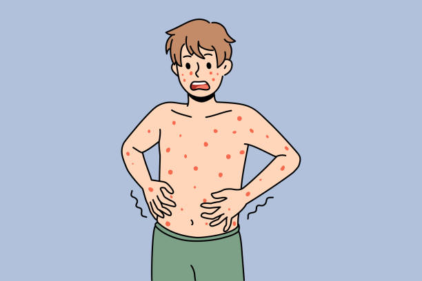 Unhealthy man have red spots suffer from illness Unhealthy boy with red spots on body suffer from measles or rubella. Anxious unwell man struggle with rash fever, have severe symptoms. Healthcare concept. Flat vector illustration. pox stock illustrations