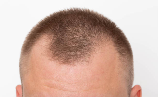 bald patches on the head of a young man. the concept of the increased hormone dihydrotestosterone. weakening of hair follicles - completely bald fotos imagens e fotografias de stock