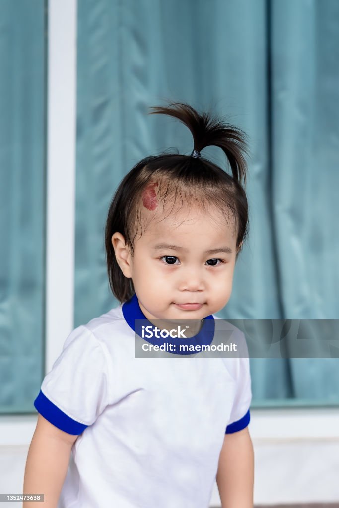 Close up of Adorable little child girl with large capillary strawberry hemangiomas red birthmark on head. Close up of Adorable little child girl with large capillary strawberry hemangiomas red birthmark on head. Happy smiling girl, a positive female kid, looking at mother or someone. Health care concept Adult Stock Photo
