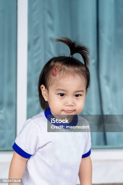 Close Up Of Adorable Little Child Girl With Large Capillary Strawberry Hemangiomas Red Birthmark On Head Stock Photo - Download Image Now