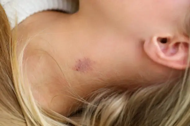 Close-up of womans neck with small bruise. Blue and red colour mark on female skin. Hickey or love bite. Domestic violence or simple body injury concept