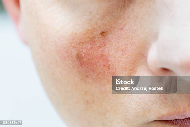 Rotes Gesicht Gebrochene Blutgefäße Gesundheitliche Probleme Stockfoto und mehr Bilder von Haut