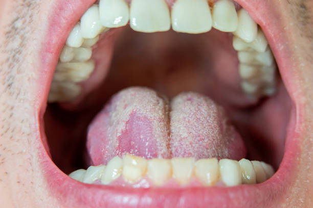 Caucasian male tongue with yeast infection candida. Macro close up shot, unrecognizable stock photo