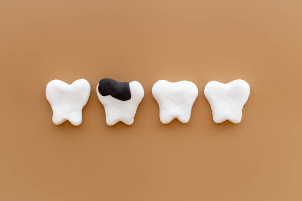 istock Dental health concept. Teeth models with caries or plaque 1352708680