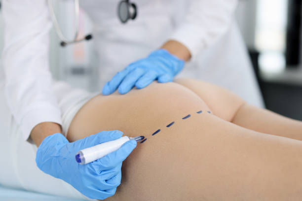 le médecin dessine des marques sur les fesses du patient avec un marqueur pour la mise en forme du corps - ass photos et images de collection