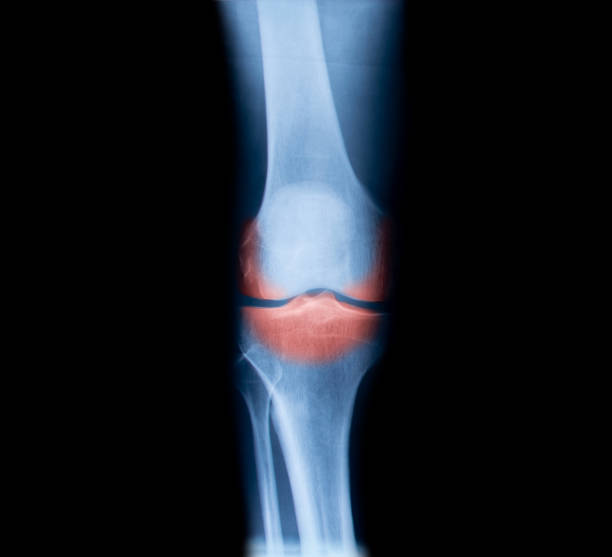 istock X-ray with osteoarthritis in the knee 1352972546