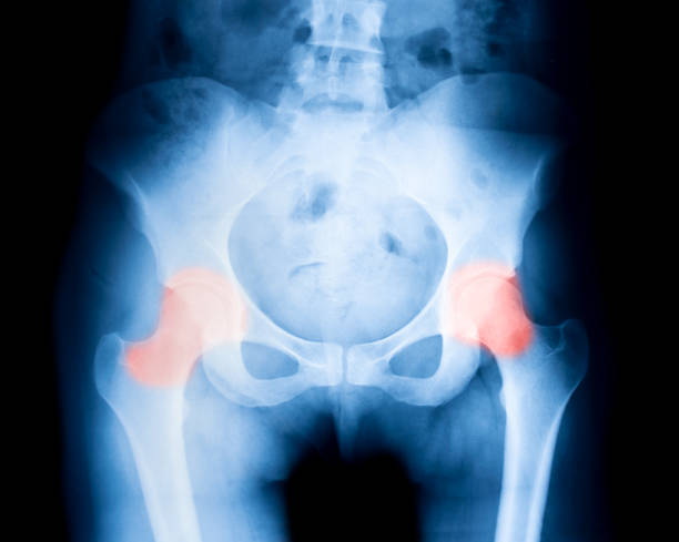 radiographie en gros plan sur l’os pelvien avec douleur - x ray image coccyx radiologist hip photos et images de collection