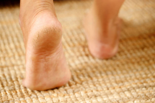 istock cracked heel treatment The foot cream should be applied regularly. 1352995333