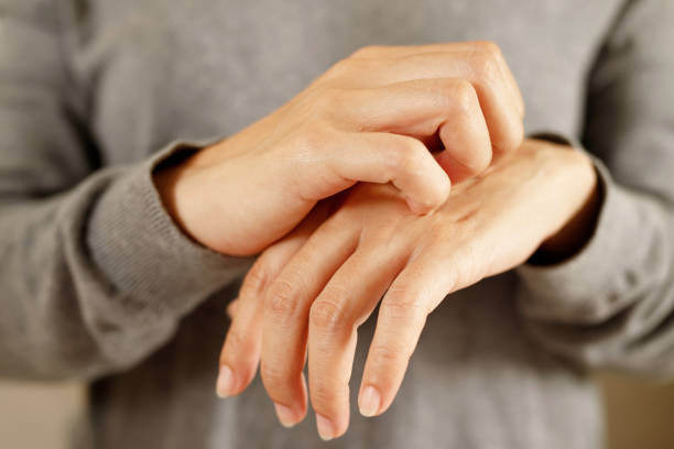 Health problems, woman has itchy hands stock photo