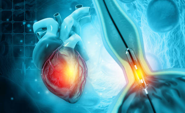 procedimiento de angioplastia con balón con stent en la vena - technology digital display digitally generated image brain fotografías e imágenes de stock