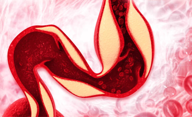 istock Cholesterol plaque in artery 1353019112