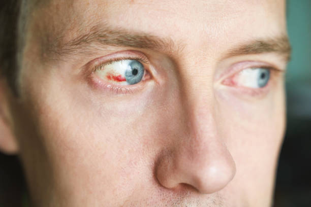 istock Man damaged eye ball. Conjunctivitis blood. Allergy ophtalmology test. 1353026721