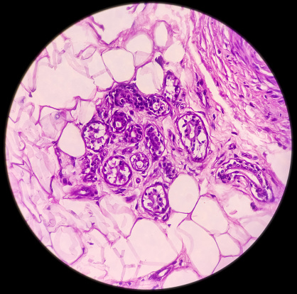 Microscopic image of malignant melanoma in pigmented ulcer. show malignant neoplasm, atypical melanocytes cells, vesicular nuclei, melanin pigmentation, selective focus