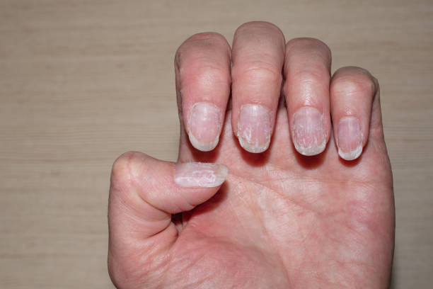 4,029 Bad Manicure Stock Photos, Pictures & Royalty-Free Images - iStock | Chipped nail polish, Chipped nail, Nail salon 4,029 Bad Manicure Stock Photos, Pictures & Royalty-Free Images - iStock | Chipped nail polish, Chipped nail, Nail salon