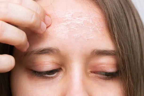 Close-up of a female forehead with peeling skin isolated on a white background. Allergies, eczema, psoriasis, lack of vitamins, erythema, itching