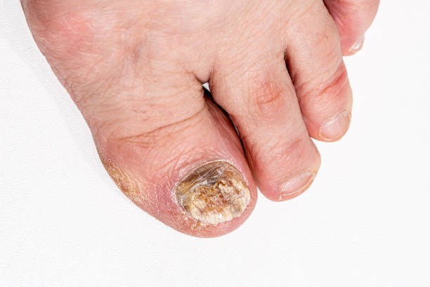 足の爪の痛み、爪の真菌を閉じます。足の病気の爪。白い背景に足の爪の真菌。 - fungus toenail human foot onychomycosis ストックフォトと画像