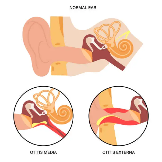 Vector illustration of External media otitis