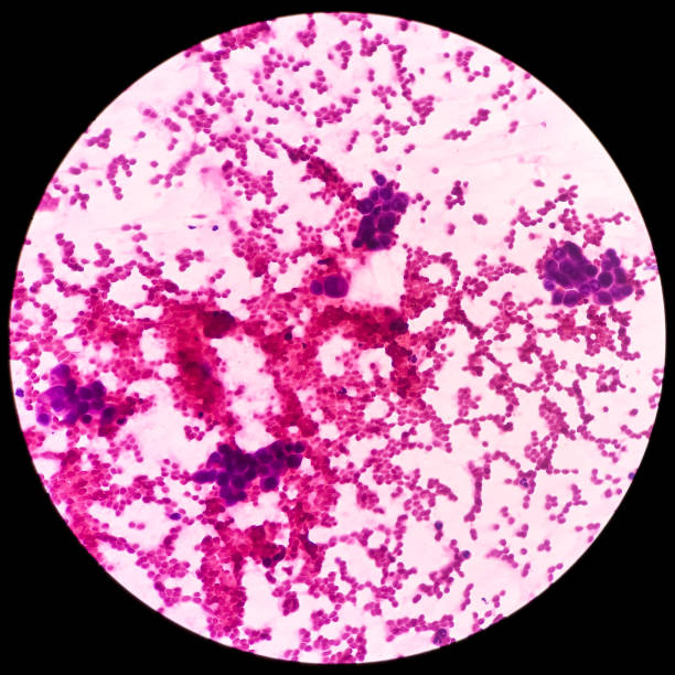 istock Microscopic view of FNAC showing malignant cell consistent with mucoepidermoid carcinoma 1353323730