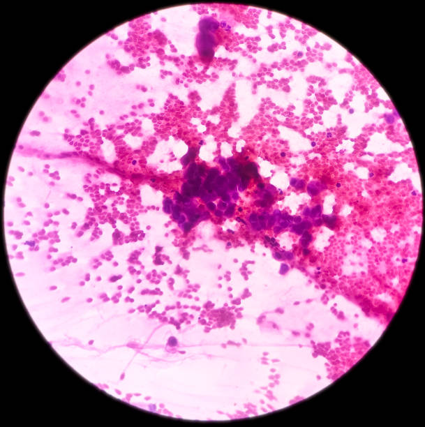 istock Microscopic view of FNAC showing malignant cell consistent with mucoepidermoid carcinoma 1353323769