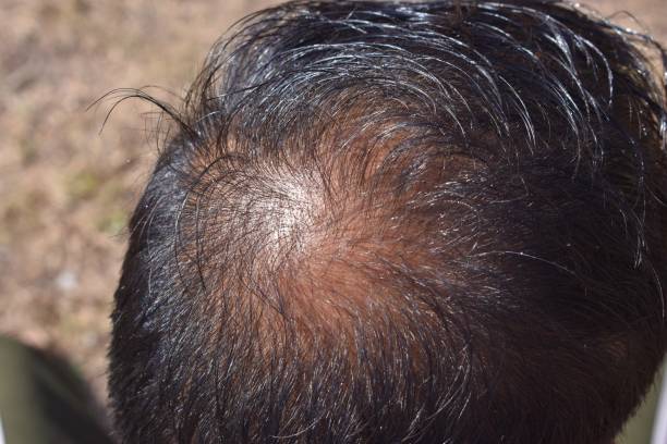 male baldness, hair loss, early baldness closeup, the concept of scalp health - indian falls imagens e fotografias de stock