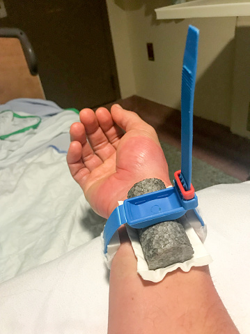 관상 동맥 혈관 조영 술 후 손목에 지혈대 건강 진단에 대한 스톡 사진 및 기타 이미지 - 건강 진단, 건강관리와 의술, 남자 ... 관상 동맥 혈관 조영 술 후 손목에 지혈대 건강 진단에 대한 스톡 사진 및 기타 이미지 - 건강 진단, 건강관리와 의술, 남자 ...
