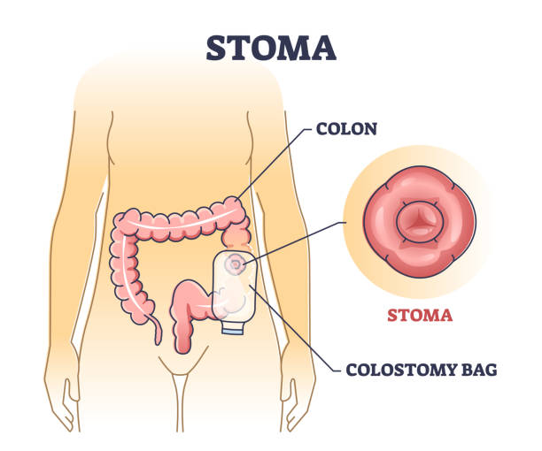 https://media.istockphoto.com/id/1353539284/vector/stoma-bag-after-colon-surgery-as-medical-patient-drainage-outline-diagram.jpg?s=612x612&w=0&k=20&c=_ZOWC39cc46ept28f3F4no4CS8xizF8x_j2iuRyQskY=