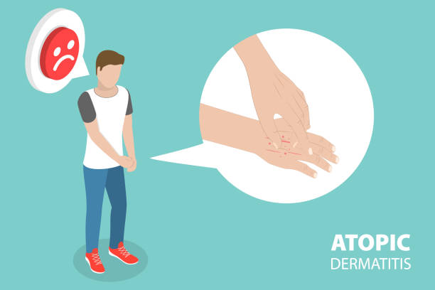 3D Isometric Flat Vector Conceptual Illustration of Atopic Dermatitis 3D Isometric Flat Vector Conceptual Illustration of Atopic Dermatitis, Unhappy Sick Man Scratch its Hand Suffering From Itch food allergy hives stock illustrations