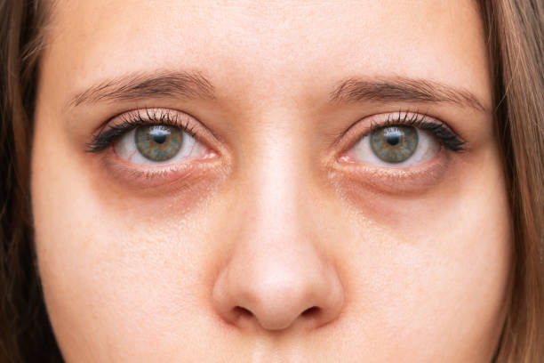 istock Green eyes with dark circles under eyes with red capillaries 1353625144