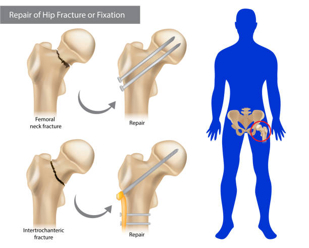 reparatur von hüftfrakturen oder fixierungen. intertrochanterische fraktur oder femurhalsfraktur. - hip replacement stock-grafiken, -clipart, -cartoons und -symbole