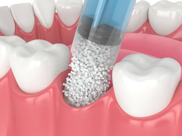 rendering 3d dell'innesto osseo dentale con applicazione di biomateriale osseo dentale - operazione di trapianto foto e immagini stock