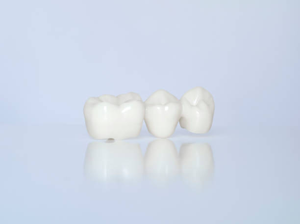 metallfreie keramik-zahnkronen - laboratory dentures dental hygiene human teeth stock-fotos und bilder